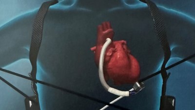 Изкуствено сърце „бие“ в гърдите на млад мъж, който чака трансплантация 